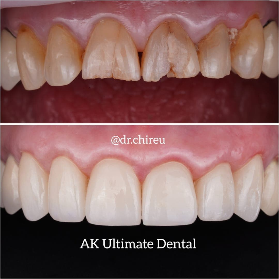 Before and after — anterior crown restoration