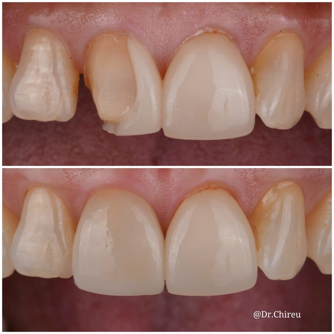 Before and after — chipped teeth restored with crowns
