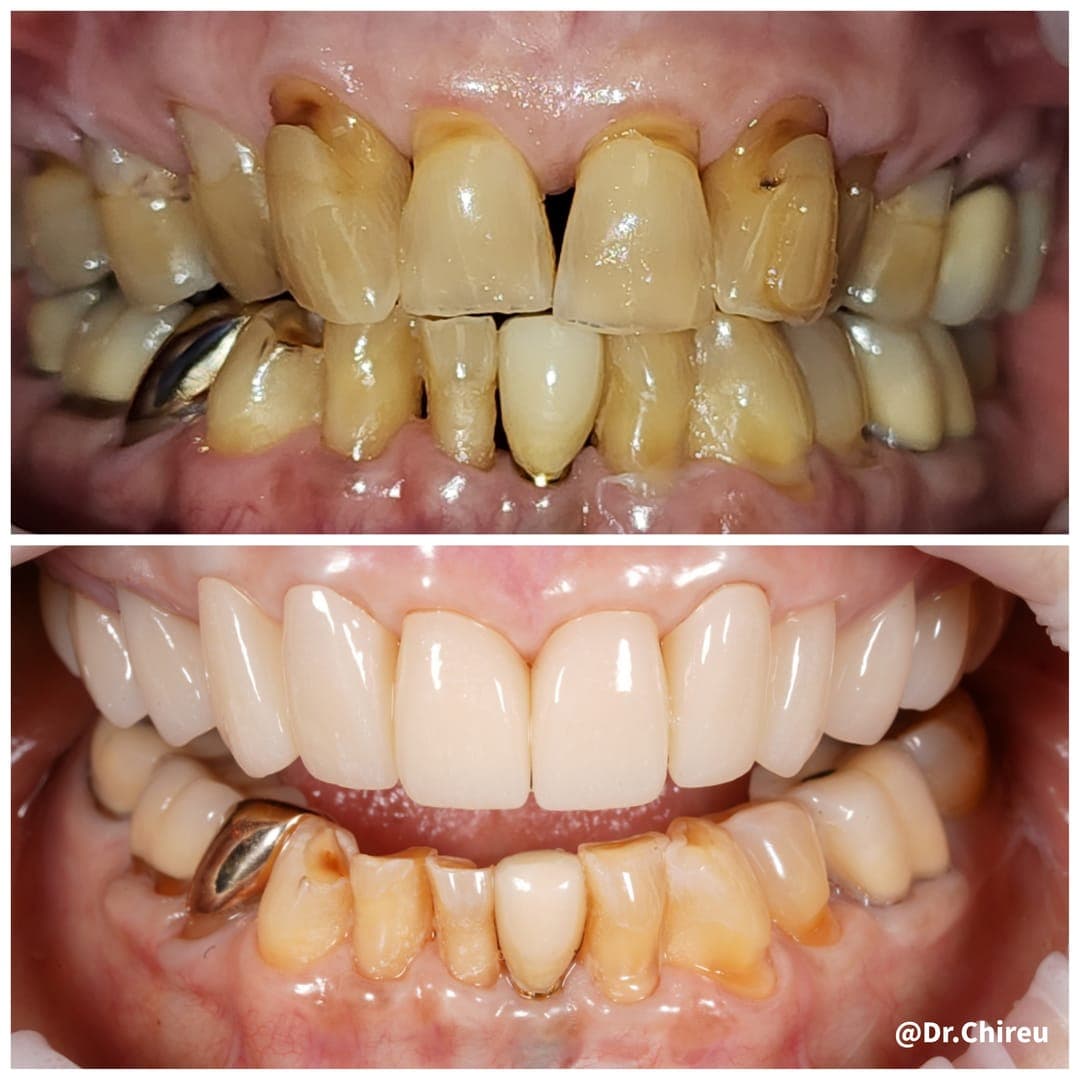 Dental Bridges procedure — AK Ultimate Dental, Las Vegas