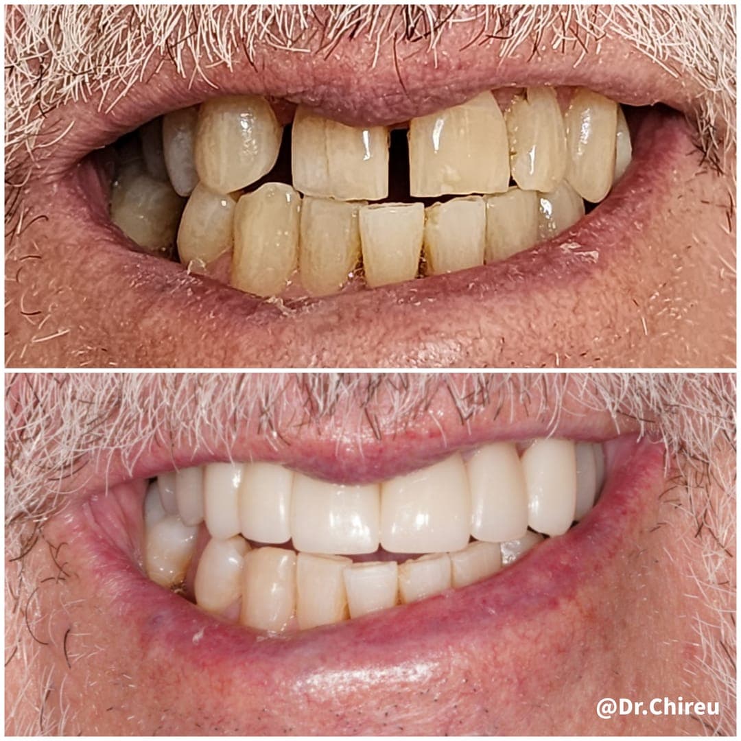Before and after — full smile restored with porcelain crowns