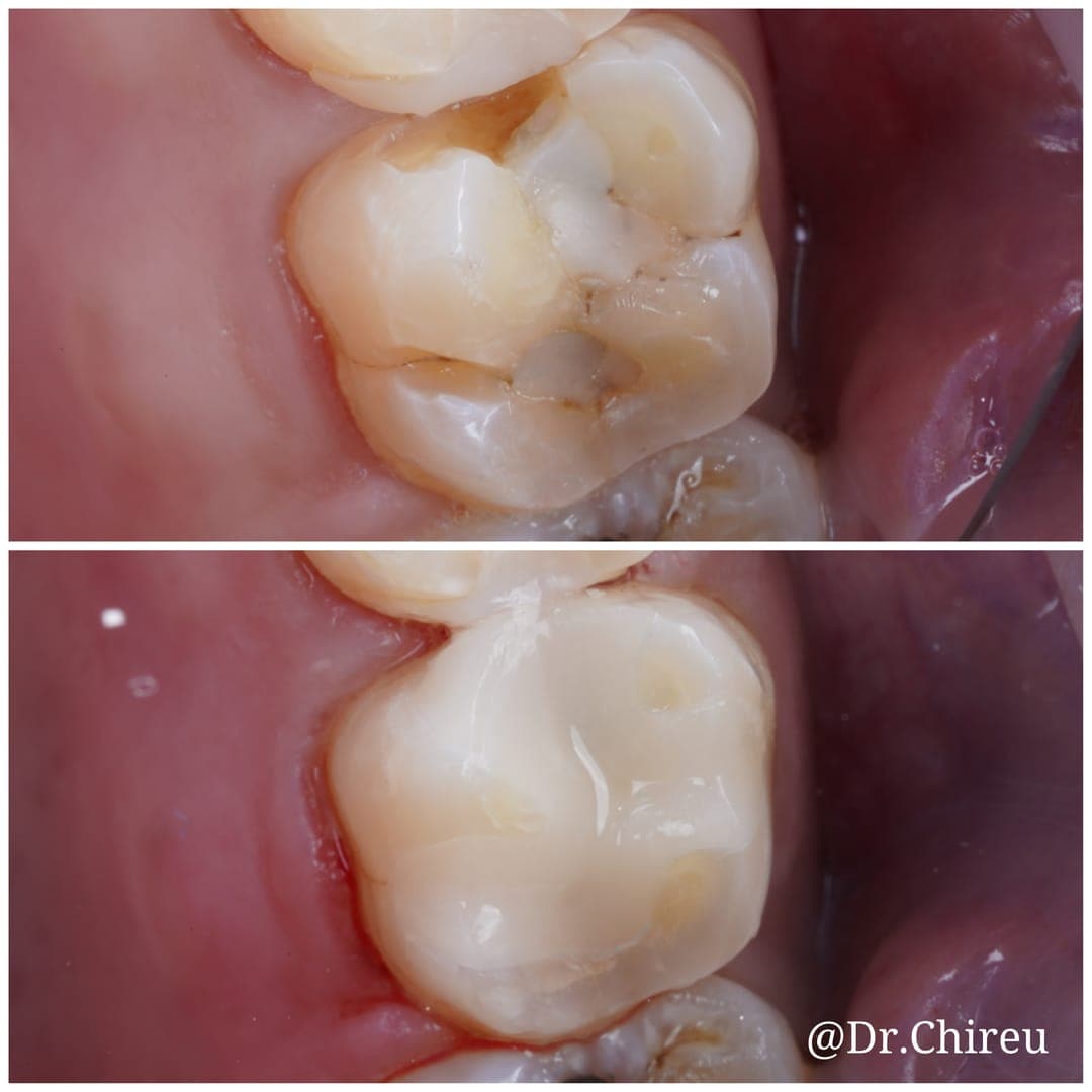 Before and after — molar ceramic crown placement