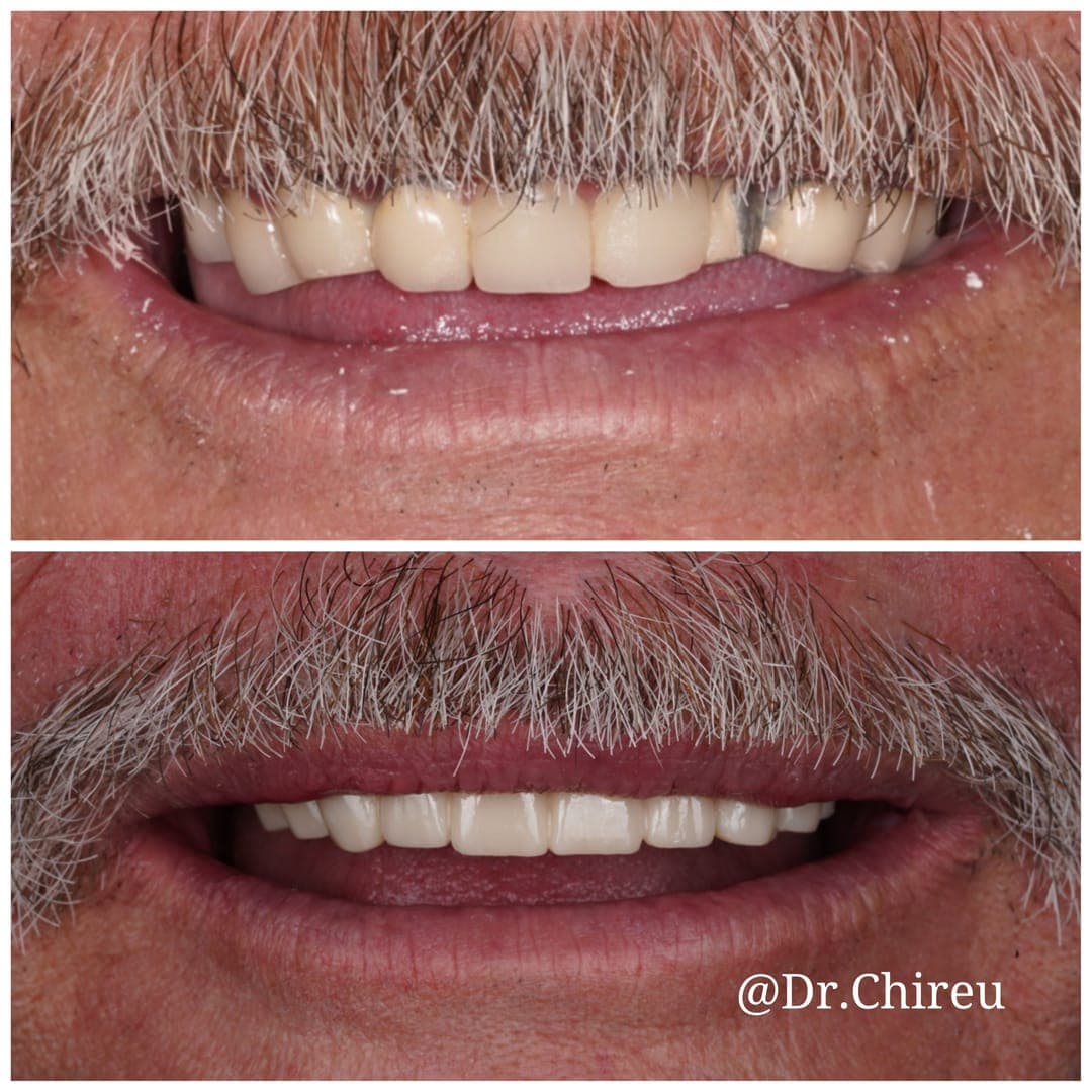 Before and after — upper arch crown restoration