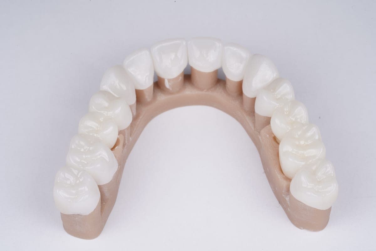 Dental Bridges