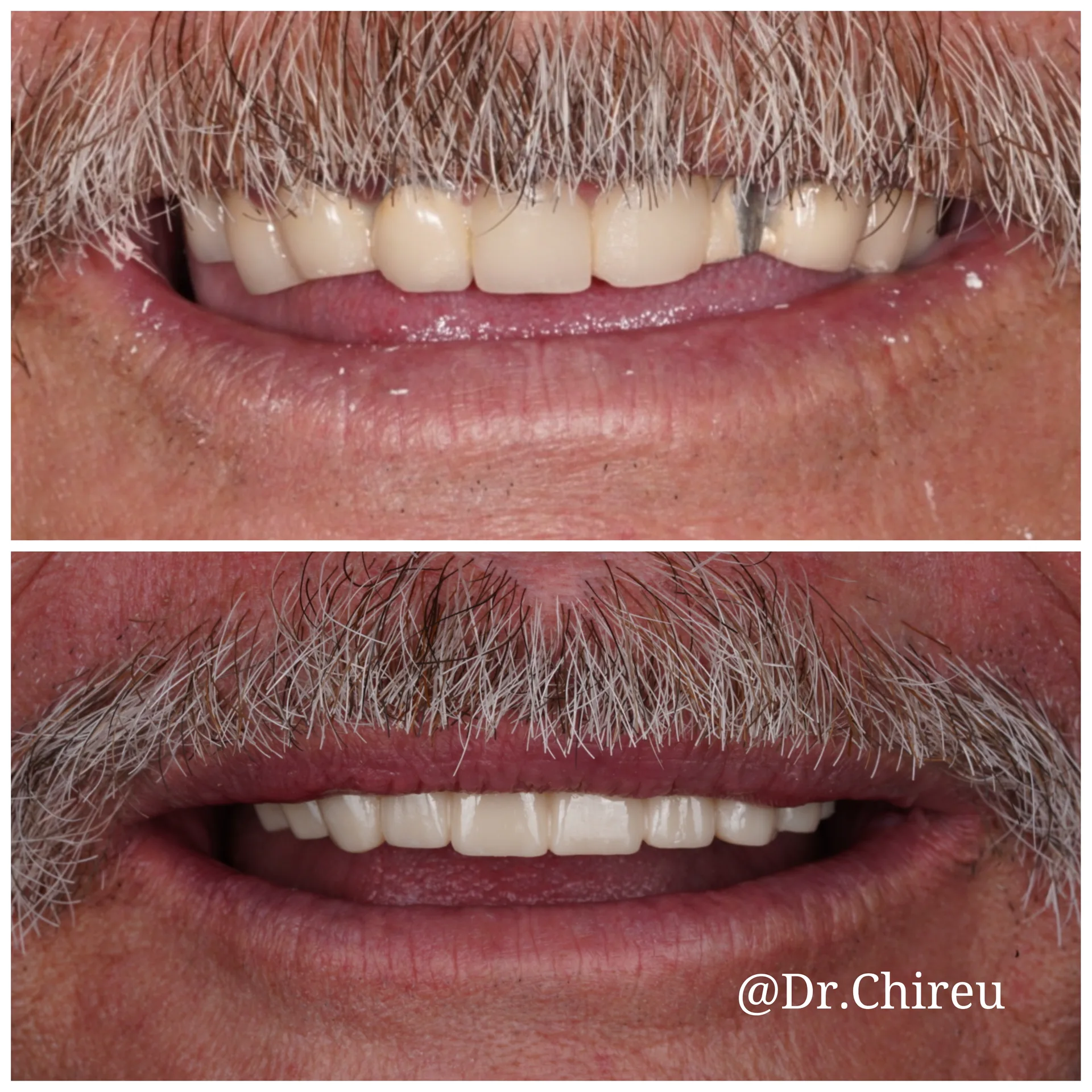 Before and after full smile crown restoration — AK Ultimate Dental Las Vegas Dr. Alex Chireau DMD