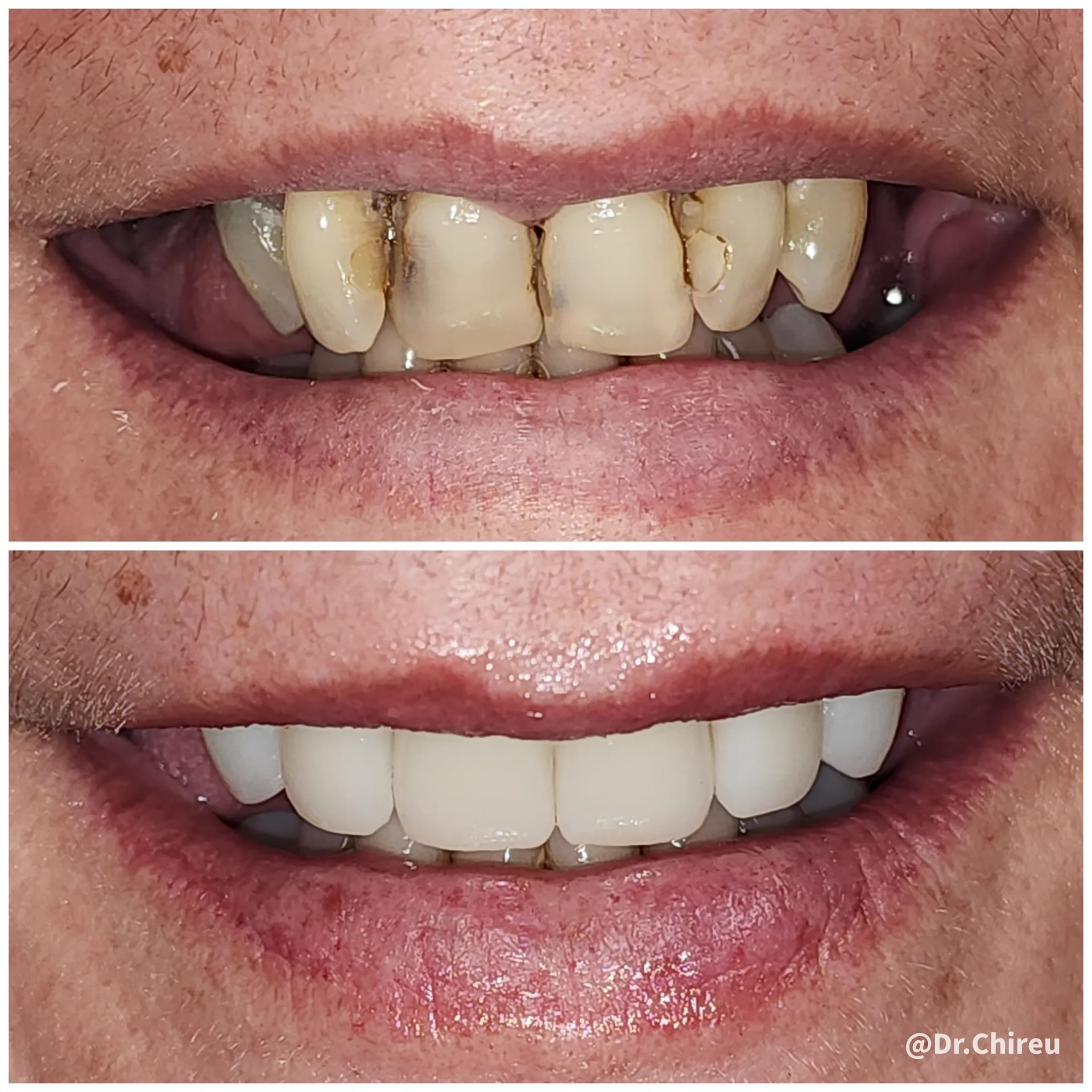 Before and after dramatic smile restoration — Dr. Alex Chireau DMD AK Ultimate Dental Las Vegas