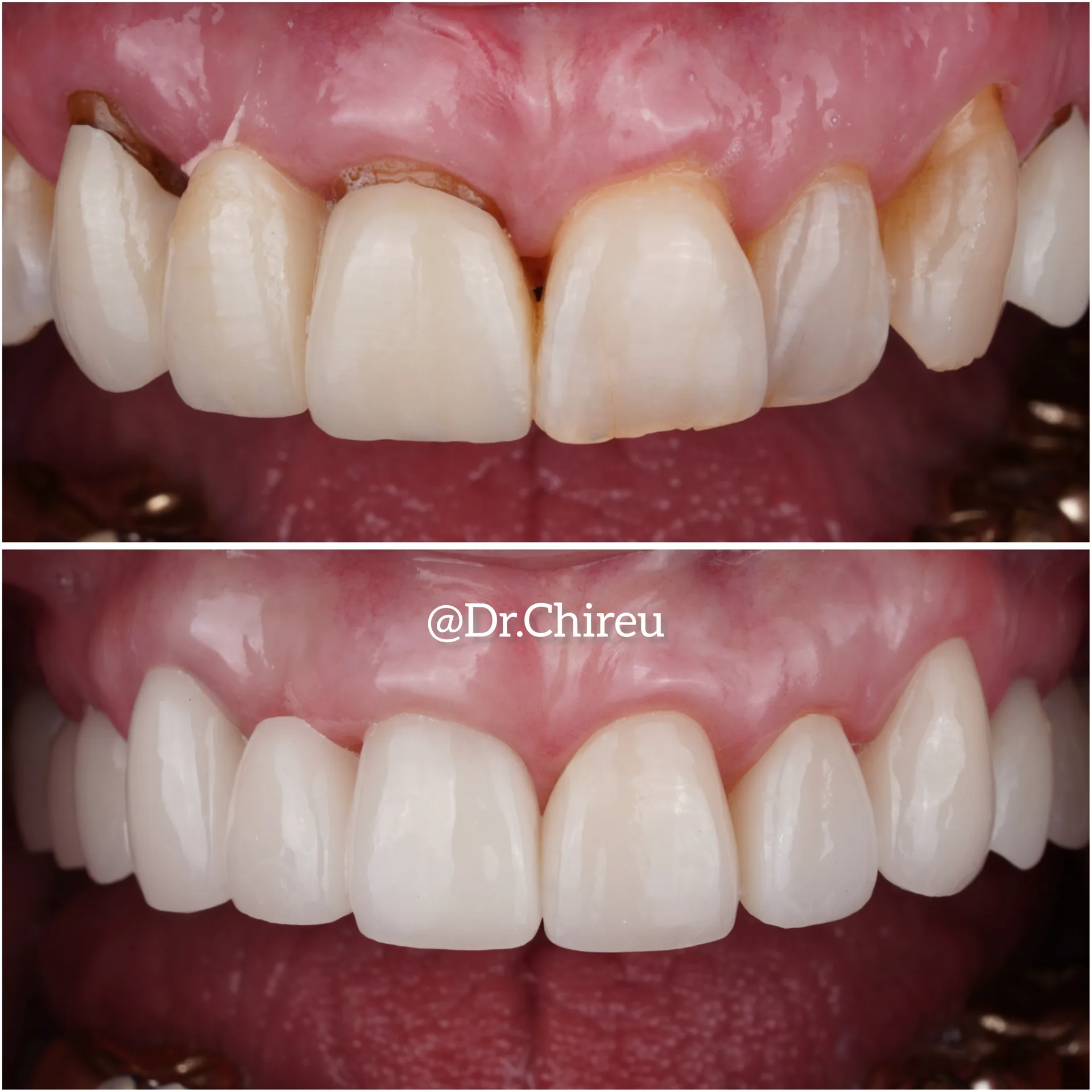 Before and after single front tooth crown — upper central incisor restored, AK Ultimate Dental Las Vegas