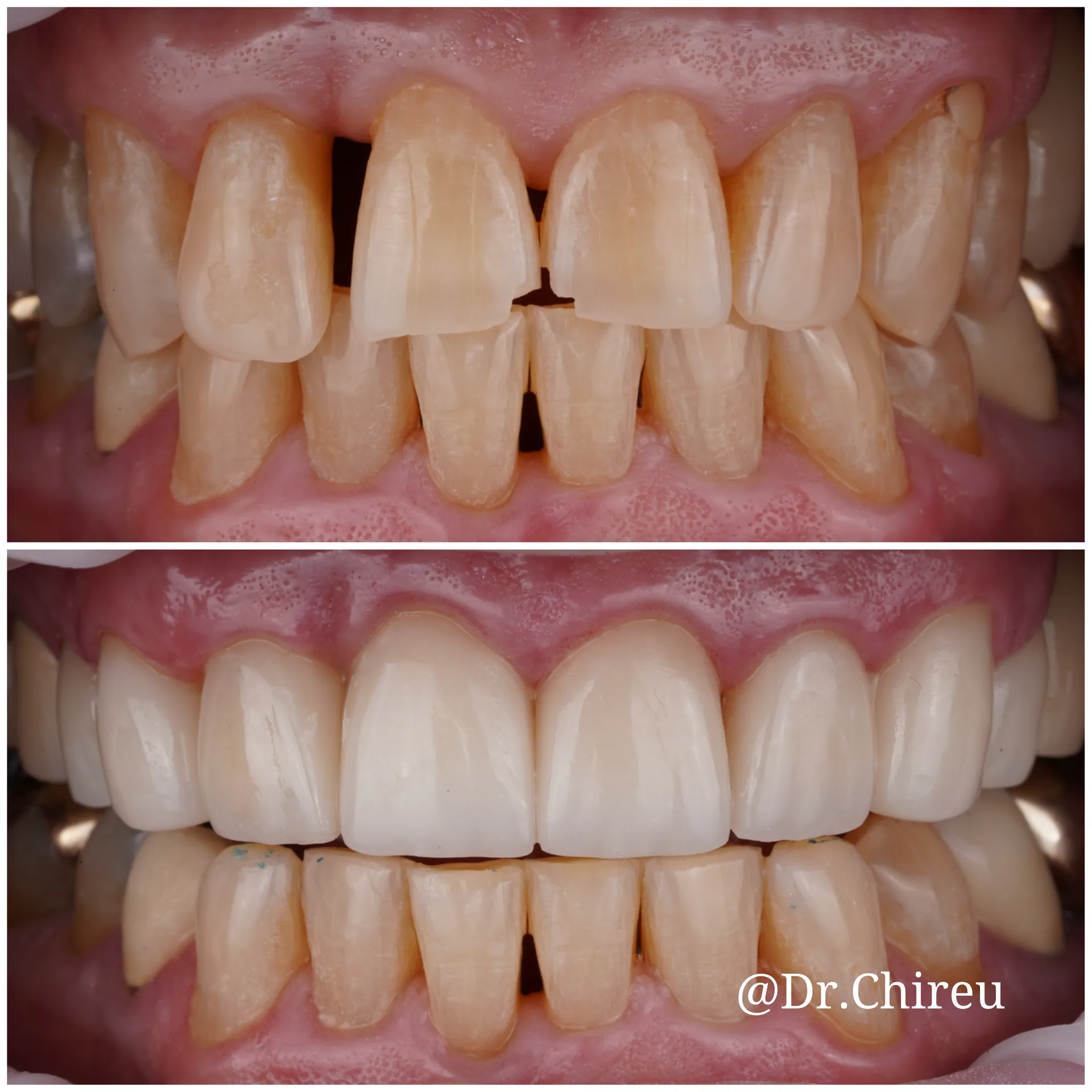 Porcelain Veneers procedure — AK Ultimate Dental, Las Vegas