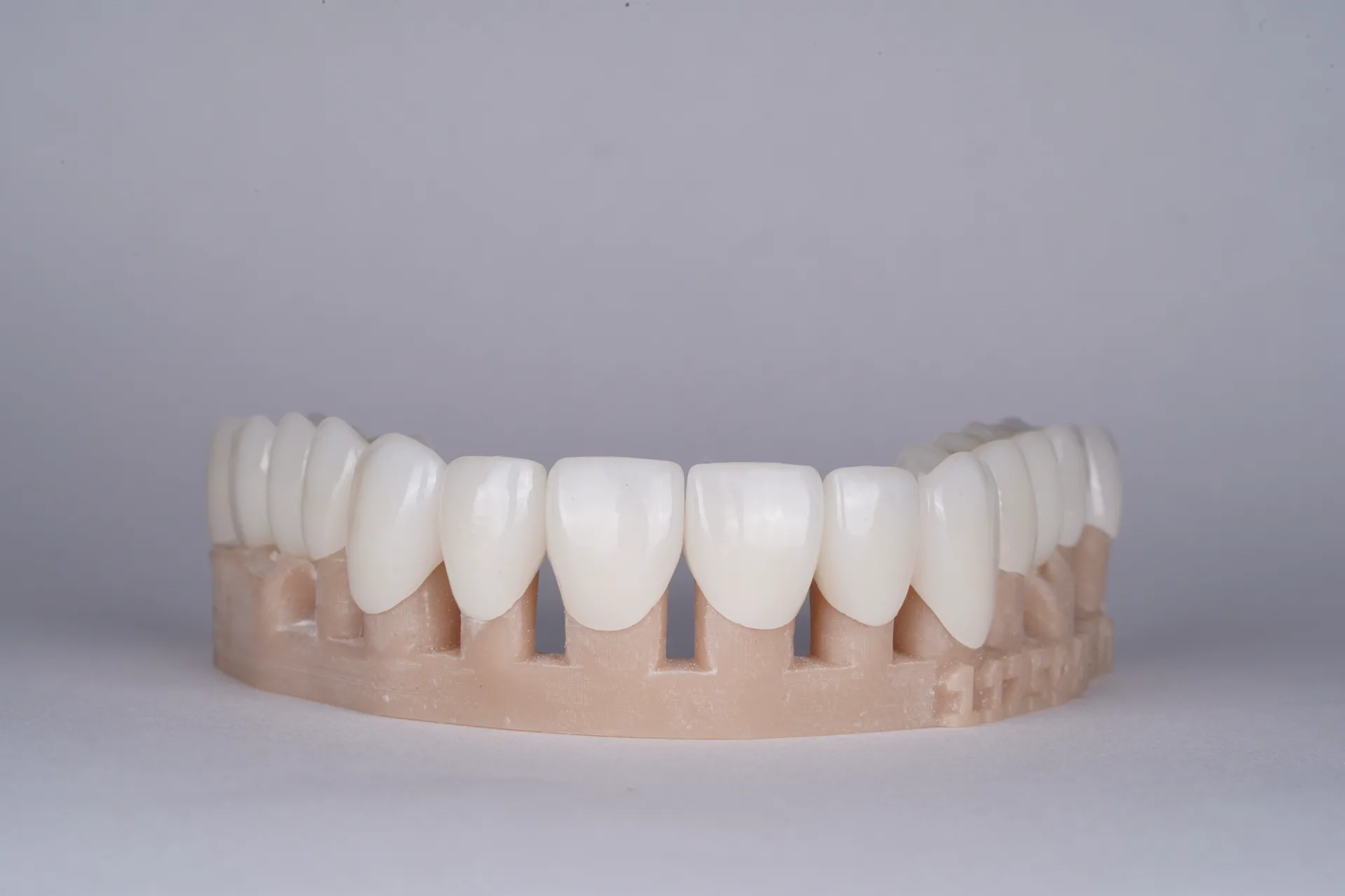 Lower arch porcelain veneer set profile view — ultra-thin ceramic craftsmanship, Dr. Alex Chireau DMD