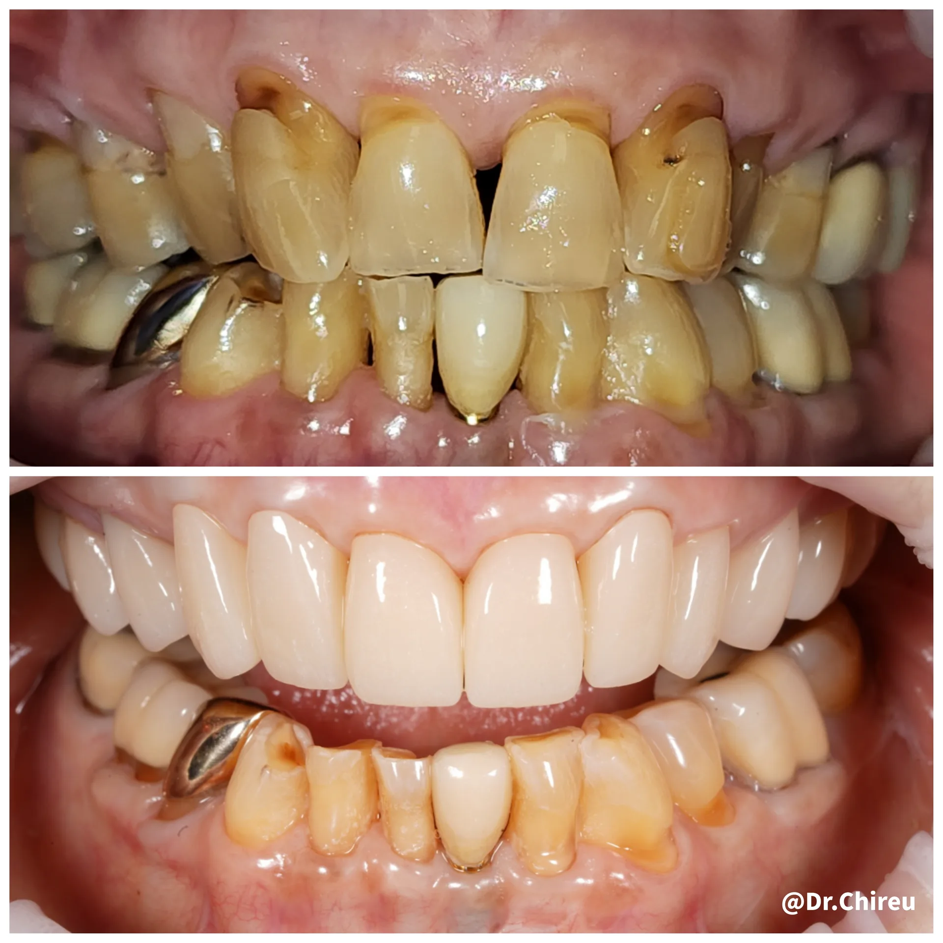 Cosmetic dentistry case work at AK Ultimate Dental, Las Vegas